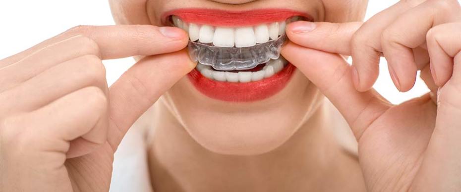 clear braces